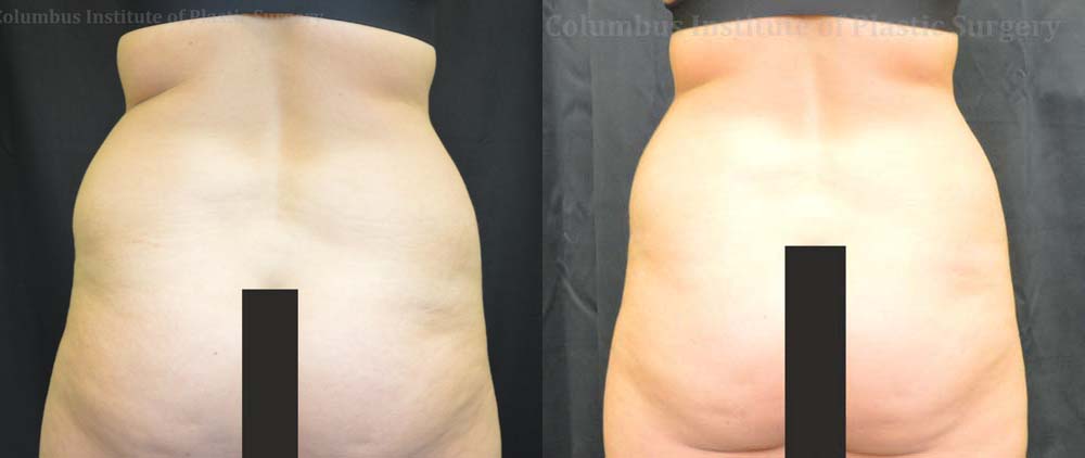 CoolSculpting before and after photo by Columbus Institute of Plastic Surgery in Columbus, OH