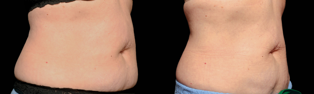 CoolSculpting before and after photo by Columbus Institute of Plastic Surgery in Columbus, OH