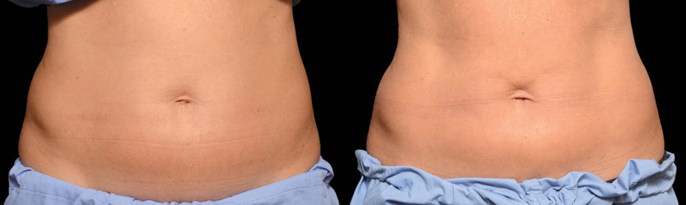 CoolSculpting before and after photo by Columbus Institute of Plastic Surgery in Columbus, OH