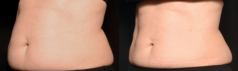 CoolSculpting before and after photo by Columbus Institute of Plastic Surgery in Columbus, OH