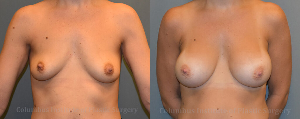 Breast Augmentation before and after photo by Columbus Institute of Plastic Surgery in Columbus, OH
