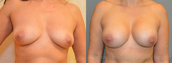 Breast Augmentation – 300cc-400cc before and after photo by Columbus Institute of Plastic Surgery in Columbus, OH