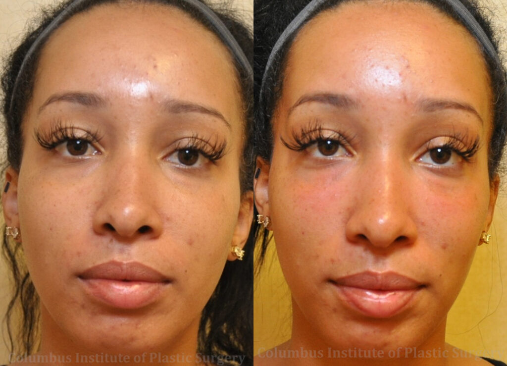 Fillers and Botox before and after photo by Columbus Institute of Plastic Surgery in Columbus, OH