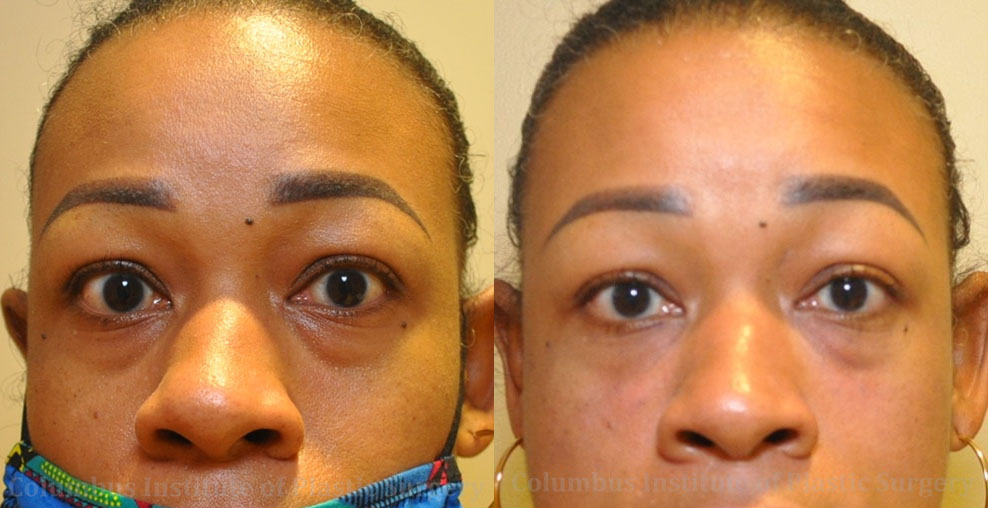 Fillers and Botox before and after photo by Columbus Institute of Plastic Surgery in Columbus, OH
