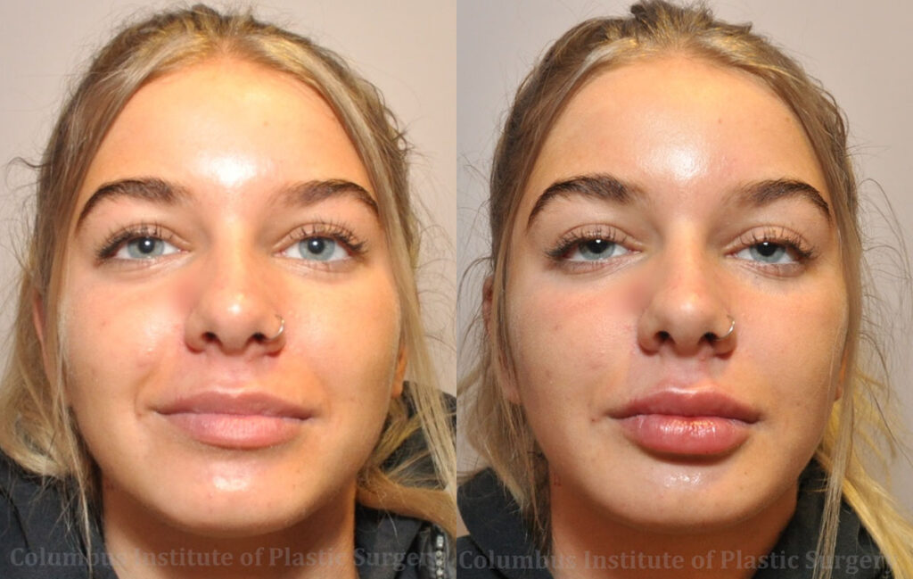 Fillers and Botox before and after photo by Columbus Institute of Plastic Surgery in Columbus, OH