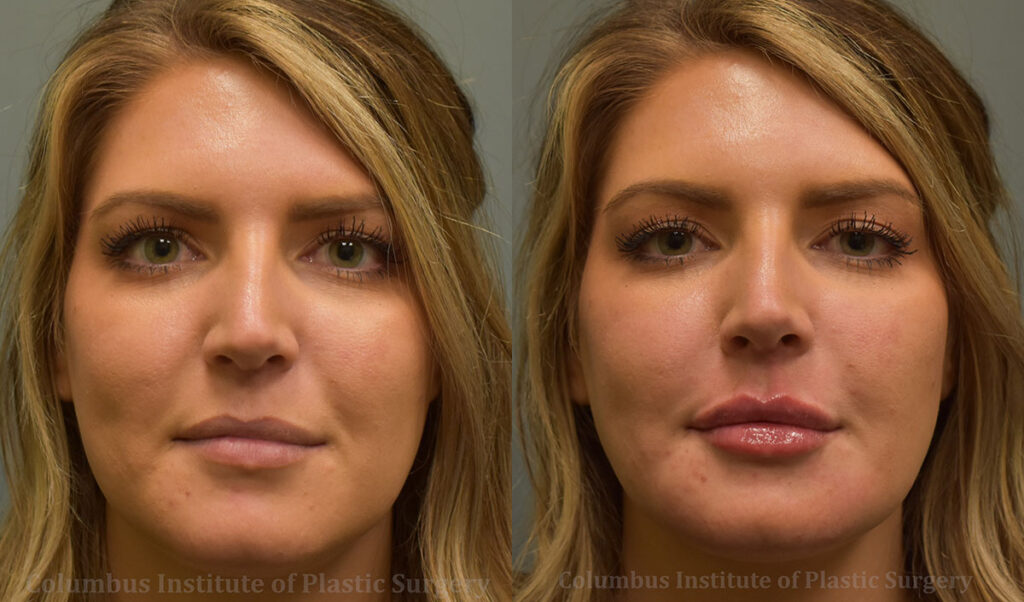 Fillers and Botox before and after photo by Columbus Institute of Plastic Surgery in Columbus, OH