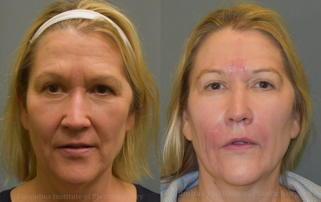 Fillers and Botox before and after photo by Columbus Institute of Plastic Surgery in Columbus, OH