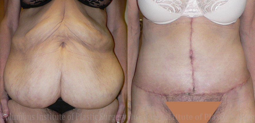 Fleur De Leis Abdominoplasty before and after photo by Columbus Institute of Plastic Surgery in Columbus, OH