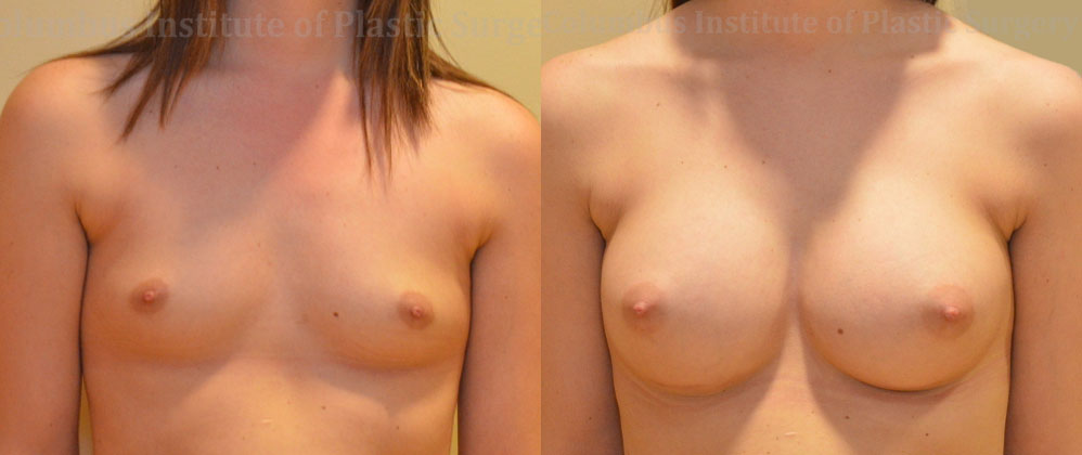 Breast Augmentation – 300cc-400cc before and after photo by Columbus Institute of Plastic Surgery in Columbus, OH