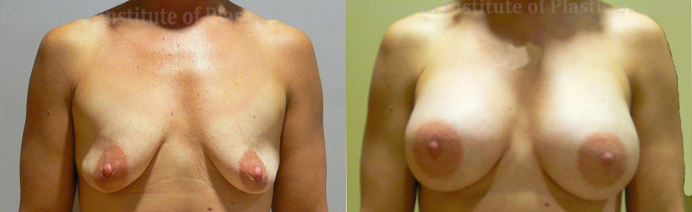 Breast Augmentation – 400cc-500cc before and after photo by Columbus Institute of Plastic Surgery in Columbus, OH
