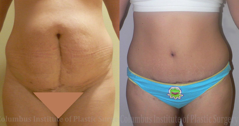 Liposuction before and after photo by Columbus Institute of Plastic Surgery in Columbus, OH
