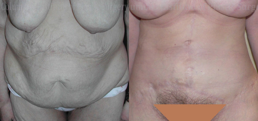 Fleur De Leis Abdominoplasty before and after photo by Columbus Institute of Plastic Surgery in Columbus, OH