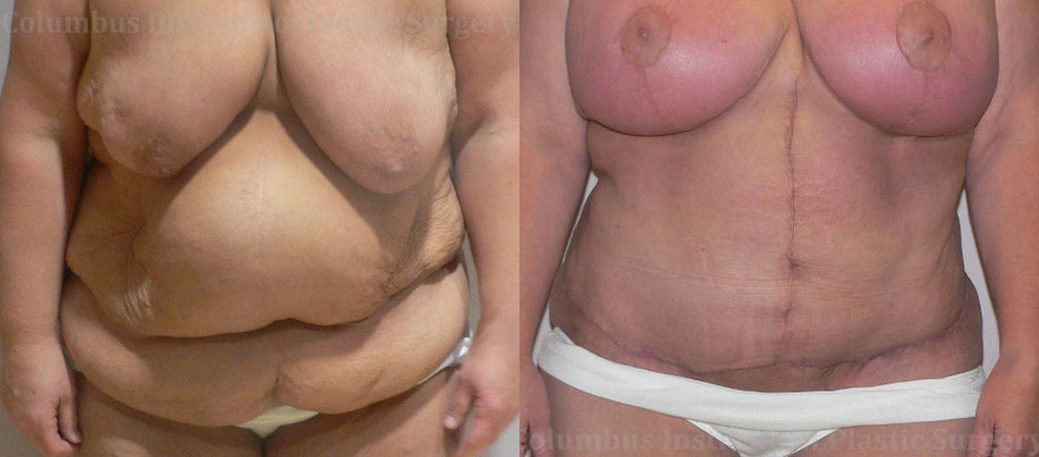 Fleur De Leis Abdominoplasty before and after photo by Columbus Institute of Plastic Surgery in Columbus, OH