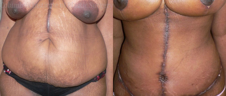 Fleur De Leis Abdominoplasty before and after photo by Columbus Institute of Plastic Surgery in Columbus, OH