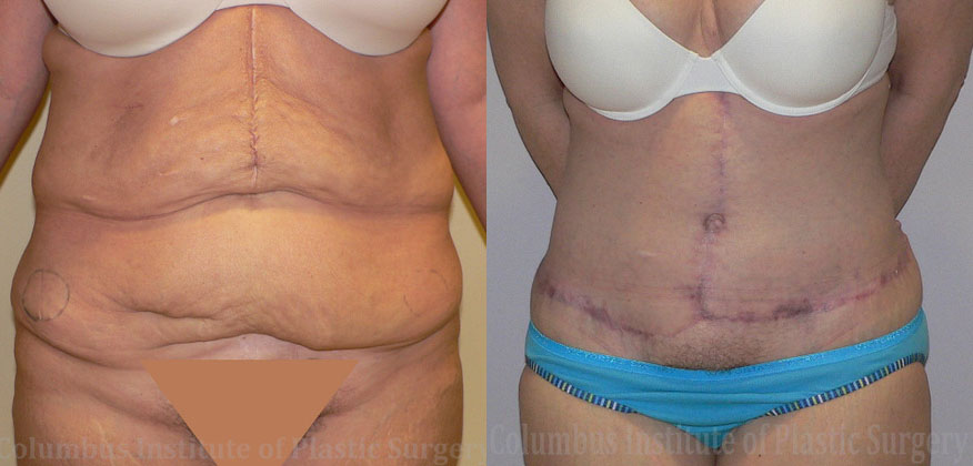 Fleur De Leis Abdominoplasty before and after photo by Columbus Institute of Plastic Surgery in Columbus, OH
