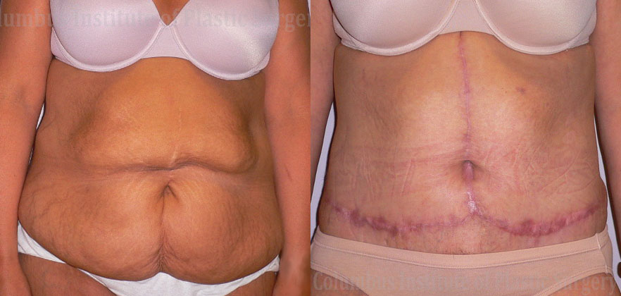 Fleur De Leis Abdominoplasty before and after photo by Columbus Institute of Plastic Surgery in Columbus, OH