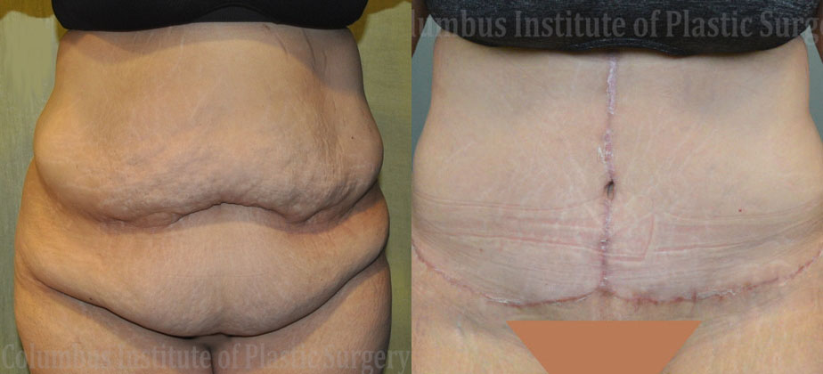 Fleur De Leis Abdominoplasty before and after photo by Columbus Institute of Plastic Surgery in Columbus, OH