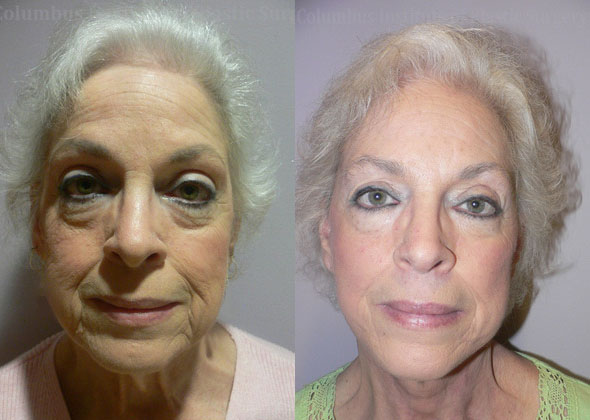 Full Facelift before and after photo by Columbus Institute of Plastic Surgery in Columbus, OH