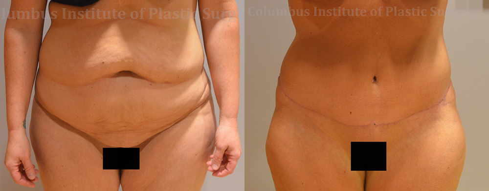 Abdominoplasty (Tummy Tuck) before and after photo by Columbus Institute of Plastic Surgery in Columbus, OH