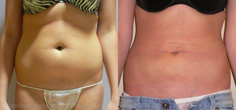 Liposuction before and after photo by Columbus Institute of Plastic Surgery in Columbus, OH
