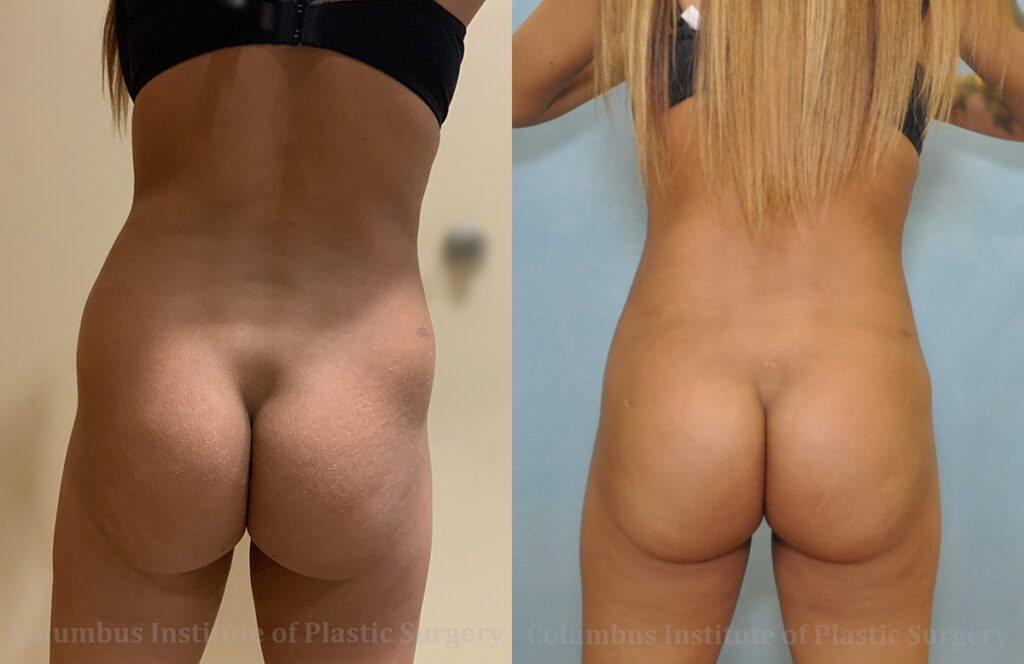Gluteal (Butt) Augmentation with Fat Grafting (Brazilian Butt Lift) before and after photo by Columbus Institute of Plastic Surgery in Columbus, OH