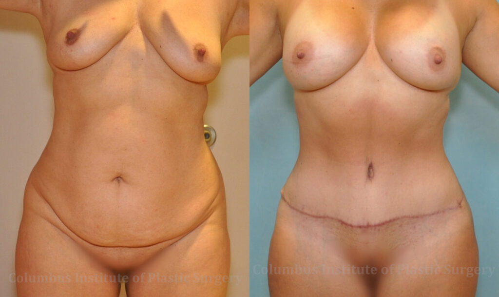 Abdominoplasty (Tummy Tuck) before and after photo by Columbus Institute of Plastic Surgery in Columbus, OH