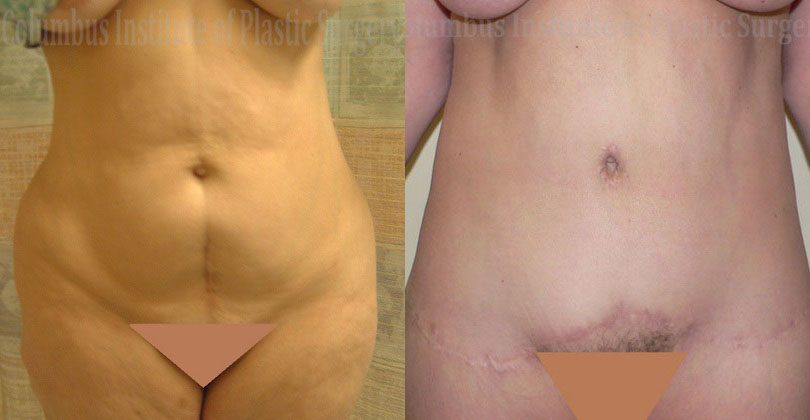 Belt Lipectomy before and after photo by Columbus Institute of Plastic Surgery in Columbus, OH