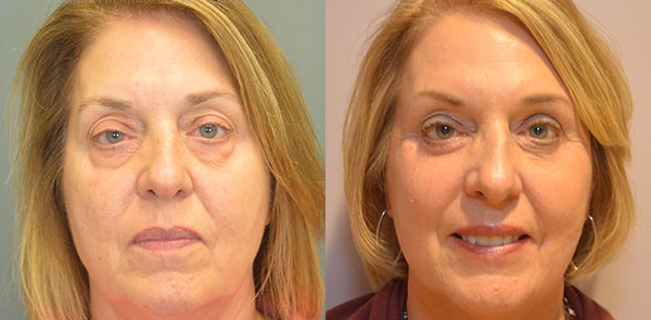 Blepharoplasty before and after photo by Columbus Institute of Plastic Surgery in Columbus, OH