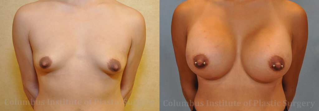 Breast Augmentation – 500cc-600cc before and after photo by Columbus Institute of Plastic Surgery in Columbus, OH