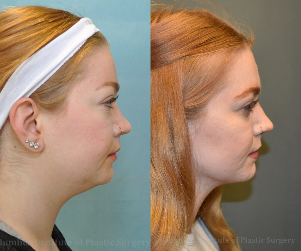 Liposuction before and after photo by Columbus Institute of Plastic Surgery in Columbus, OH