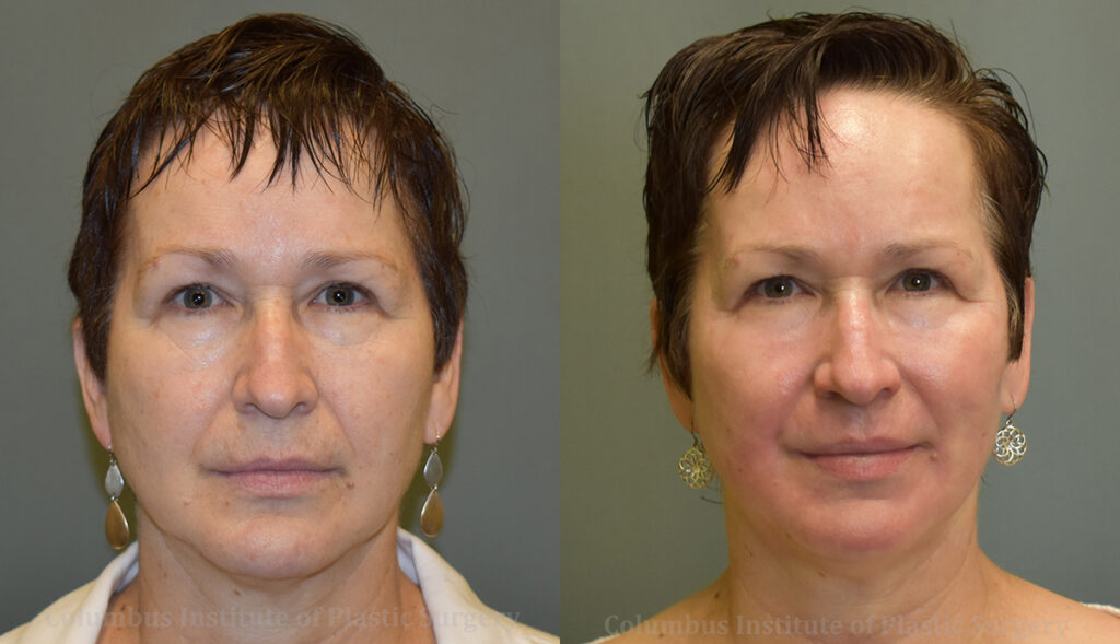 TCA Chemical Peel before and after photo by Columbus Institute of Plastic Surgery in Columbus, OH