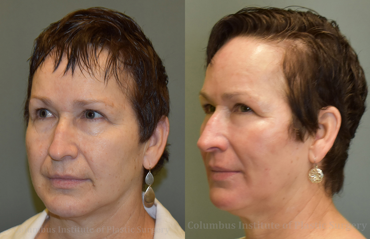 TCA Chemical Peel before and after photo by Columbus Institute of Plastic Surgery in Columbus, OH TCA Chemical Peel before and after photo by Columbus Institute of Plastic Surgery in Columbus, OH