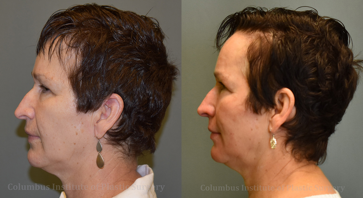 TCA Chemical Peel before and after photo by Columbus Institute of Plastic Surgery in Columbus, OH TCA Chemical Peel before and after photo by Columbus Institute of Plastic Surgery in Columbus, OH