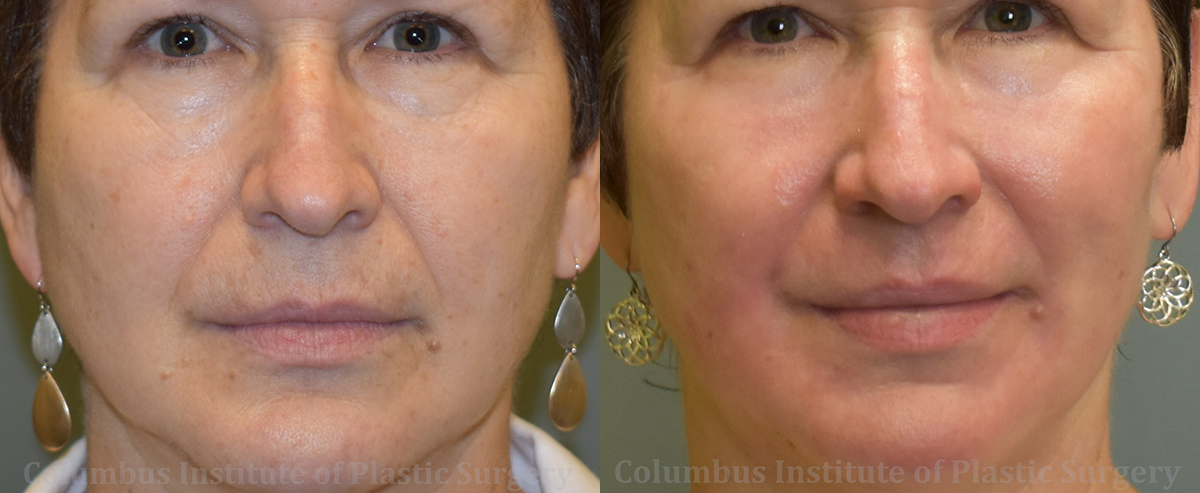 TCA Chemical Peel before and after photo by Columbus Institute of Plastic Surgery in Columbus, OH TCA Chemical Peel before and after photo by Columbus Institute of Plastic Surgery in Columbus, OH