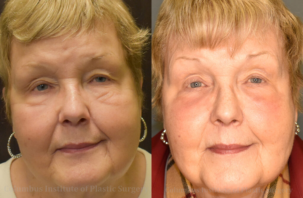 Laser Skin Resurfacing before and after photo by Columbus Institute of Plastic Surgery in Columbus, OH