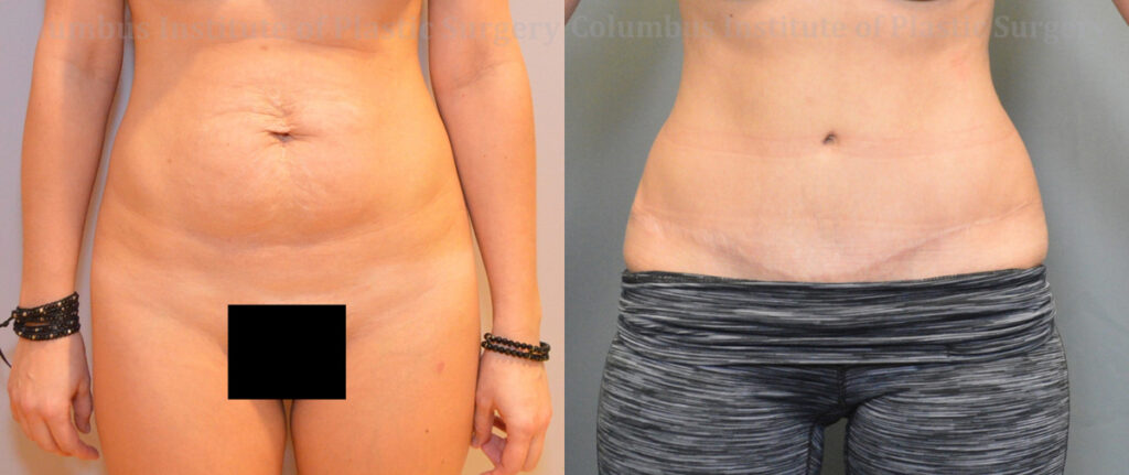 Abdominoplasty (Tummy Tuck) before and after photo by Columbus Institute of Plastic Surgery in Columbus, OH