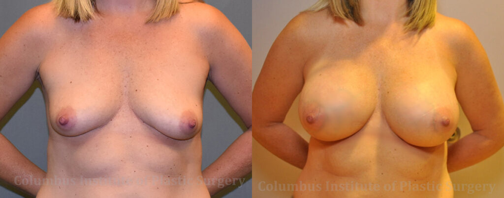 Breast Augmentation before and after photo by Columbus Institute of Plastic Surgery in Columbus, OH
