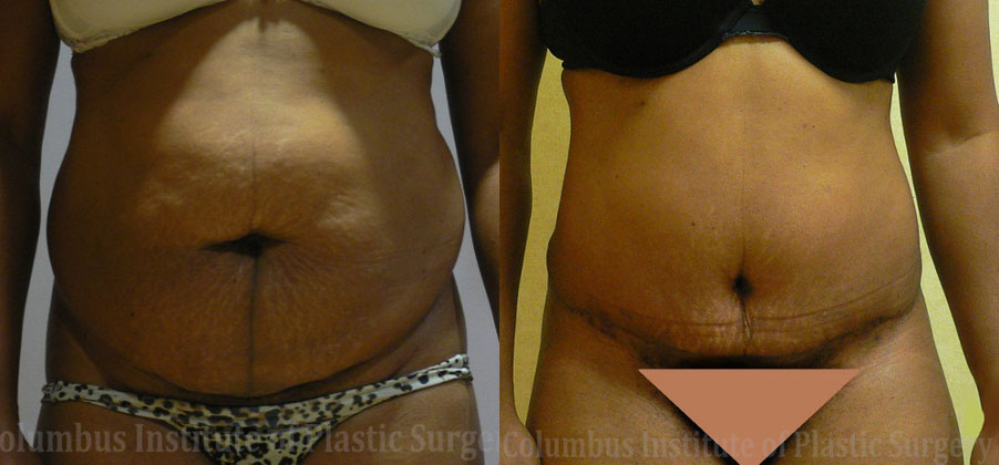 Liposuction before and after photo by Columbus Institute of Plastic Surgery in Columbus, OH
