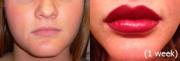 Lip Augmentation (Fillers and Implants) before and after photo by Columbus Institute of Plastic Surgery in Columbus, OH