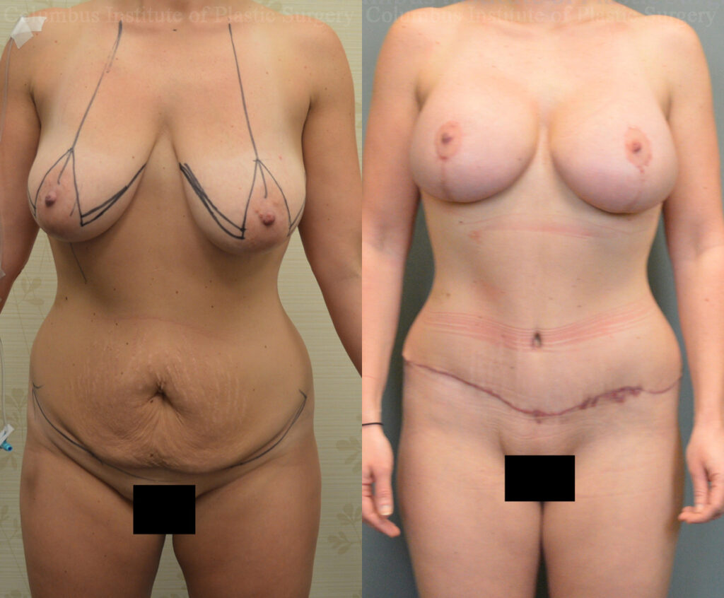 Abdominoplasty (Tummy Tuck) before and after photo by Columbus Institute of Plastic Surgery in Columbus, OH