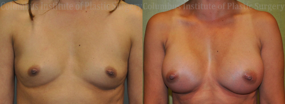 Breast Augmentation – 400cc-500cc before and after photo by Columbus Institute of Plastic Surgery in Columbus, OH