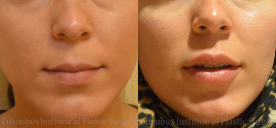 Lip Augmentation (Fillers and Implants) before and after photo by Columbus Institute of Plastic Surgery in Columbus, OH