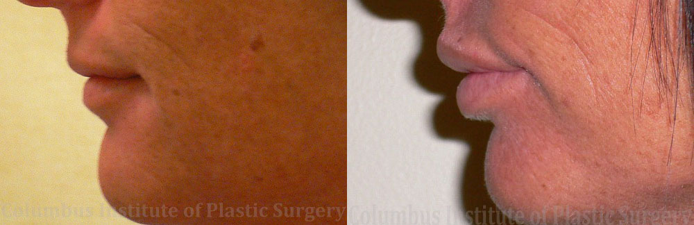 Lip Augmentation (Fillers and Implants) before and after photo by Columbus Institute of Plastic Surgery in Columbus, OH