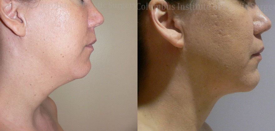 Liposuction before and after photo by Columbus Institute of Plastic Surgery in Columbus, OH