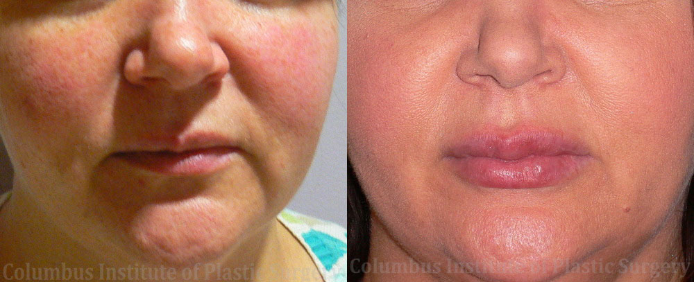 Lip Augmentation (Fillers and Implants) before and after photo by Columbus Institute of Plastic Surgery in Columbus, OH