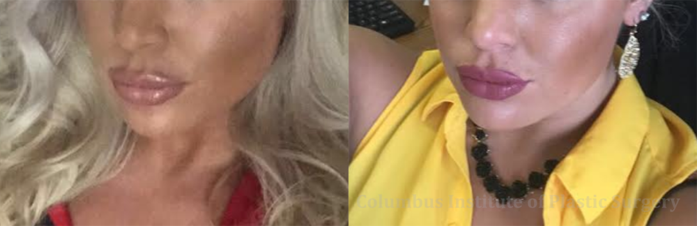 Lip Augmentation (Fillers and Implants) before and after photo by Columbus Institute of Plastic Surgery in Columbus, OH