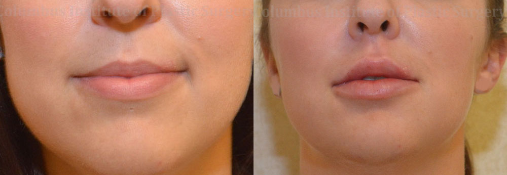 Lip Augmentation (Fillers and Implants) before and after photo by Columbus Institute of Plastic Surgery in Columbus, OH