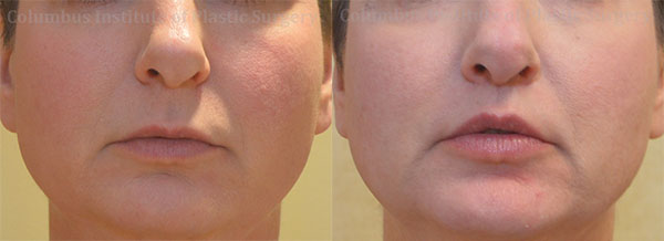 Lip Lift before and after photo by Columbus Institute of Plastic Surgery in Columbus, OH