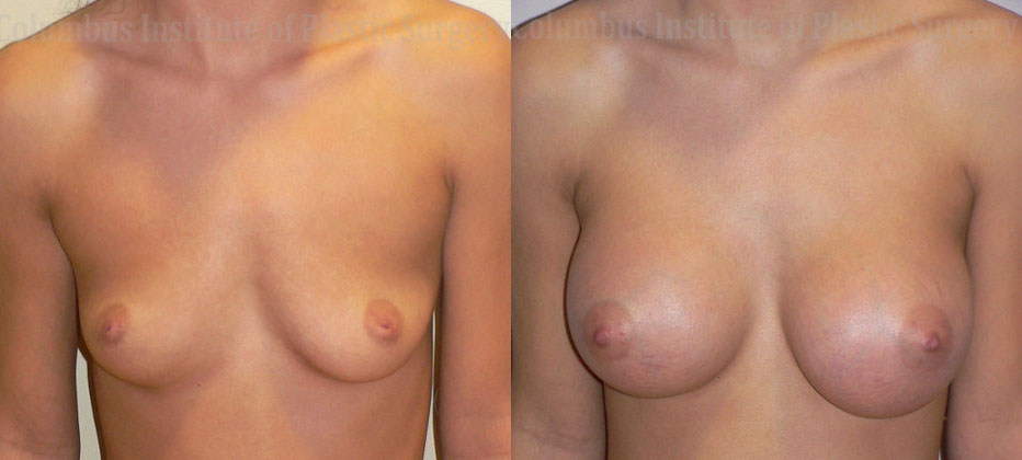 Breast Augmentation – 400cc-500cc before and after photo by Columbus Institute of Plastic Surgery in Columbus, OH