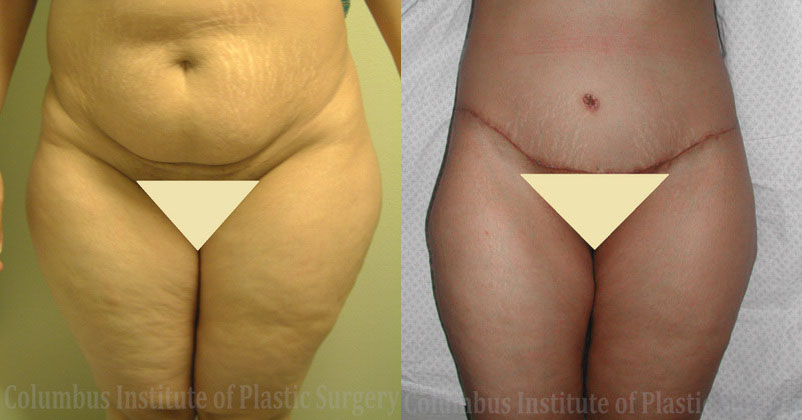 Liposuction before and after photo by Columbus Institute of Plastic Surgery in Columbus, OH